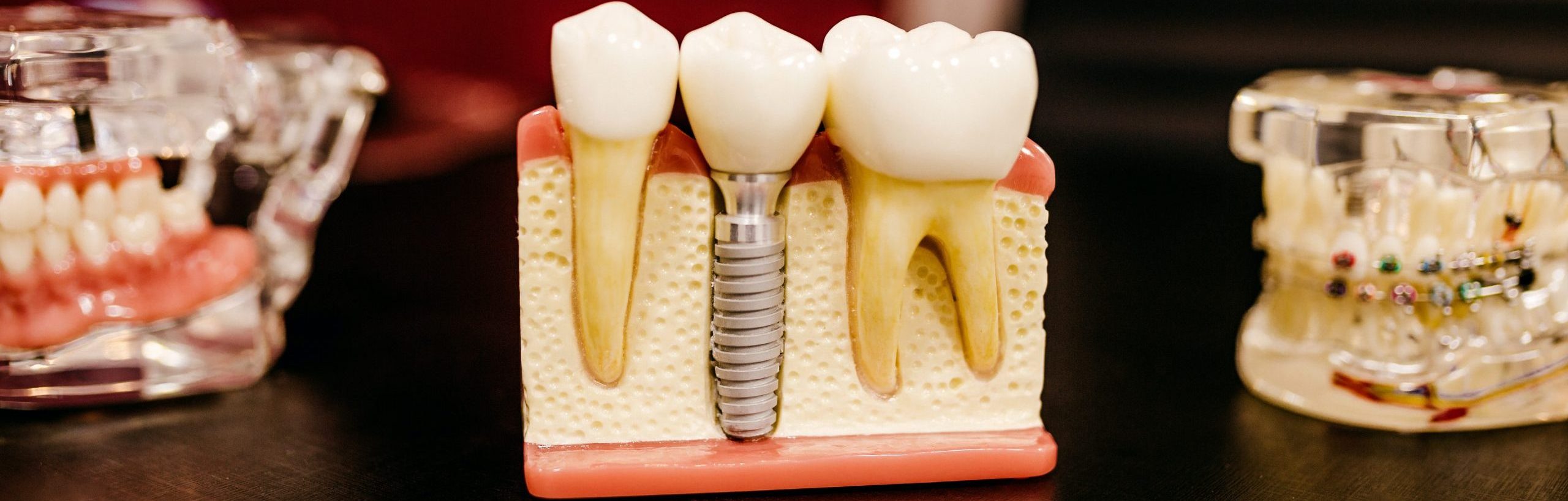 Implantacija ir protezavimas